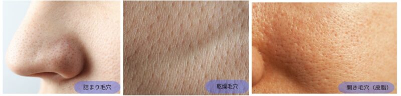 毛穴の開きが気になる方へ｜原因・治療法・皮膚科でのおすすめ施術【赤坂の皮膚科専門医が解説】のアイキャッチ画像