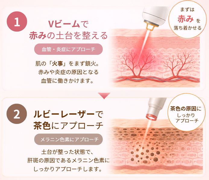 Vビームとルビーレーザーを組み合わせた肝斑治療の流れを示す図