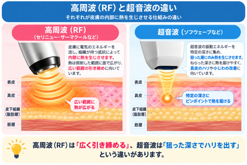 高周波(RF)と超音波がそれぞれ皮膚の内部に熱を生じさせる仕組みの違いを示す図解