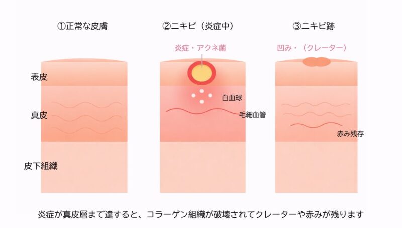ニキビ跡のクレーター(凸凹肌)治療|キュアジェット・ジュベルックで改善できる理由【赤坂の皮膚科専門医が解説】のアイキャッチ画像