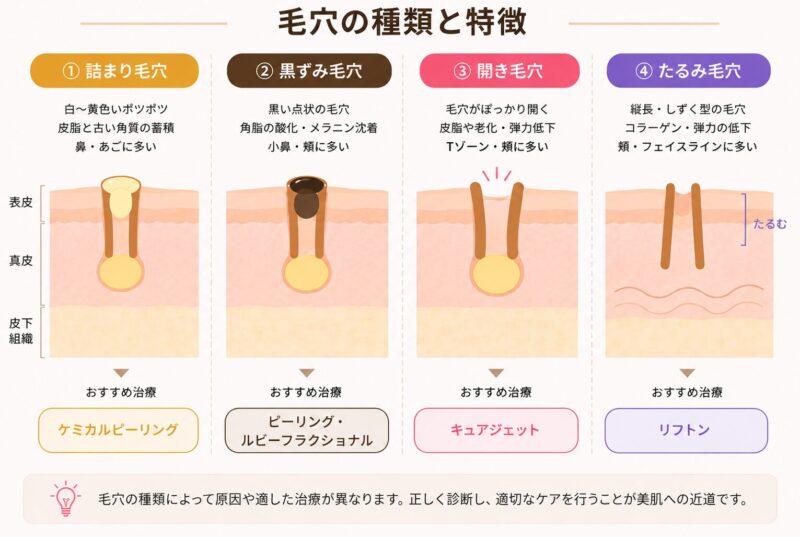 毛穴の種類と特徴。特徴に合わせたおすすめ治療の説明
