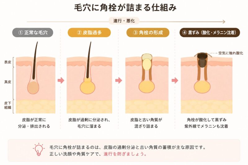 毛穴に各線が詰まる仕組みの説明