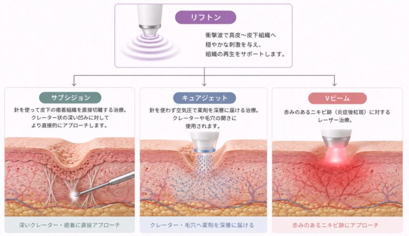 リフトン・サブシジョン・キュアジェット・Vビームの組み合わせ関係を示す図解
