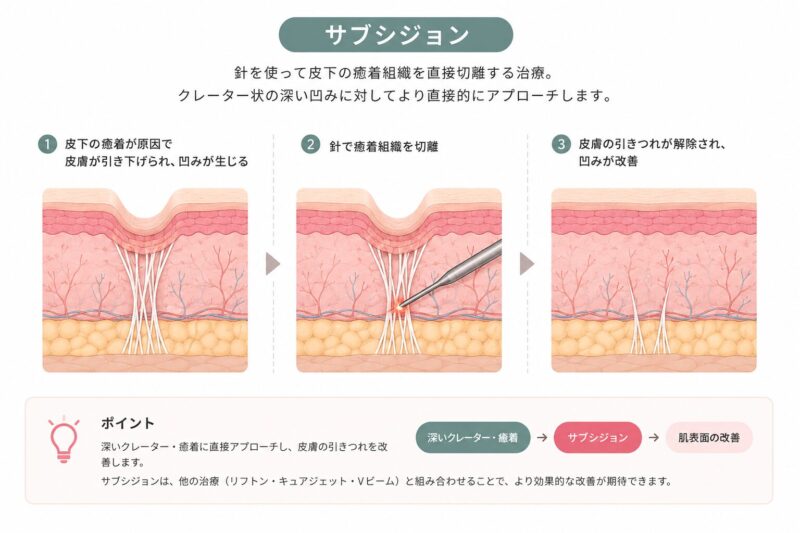 なかなか改善しないそのニキビ跡、サブシジョンで解決?!「癒着」に直接アプローチ【赤坂の皮膚科専門医が解説】のアイキャッチ画像