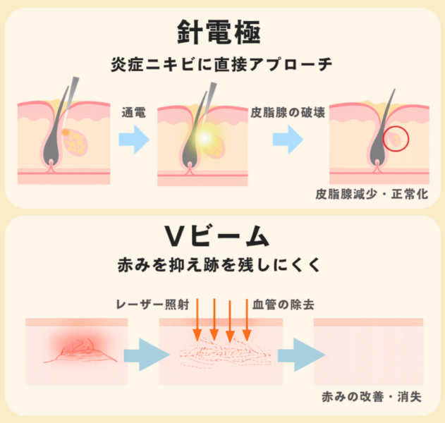 針電極による皮脂腺への通電・破壊のプロセスとVビームによるレーザー照射で血管を除去し赤みを改善する仕組みを示した図解