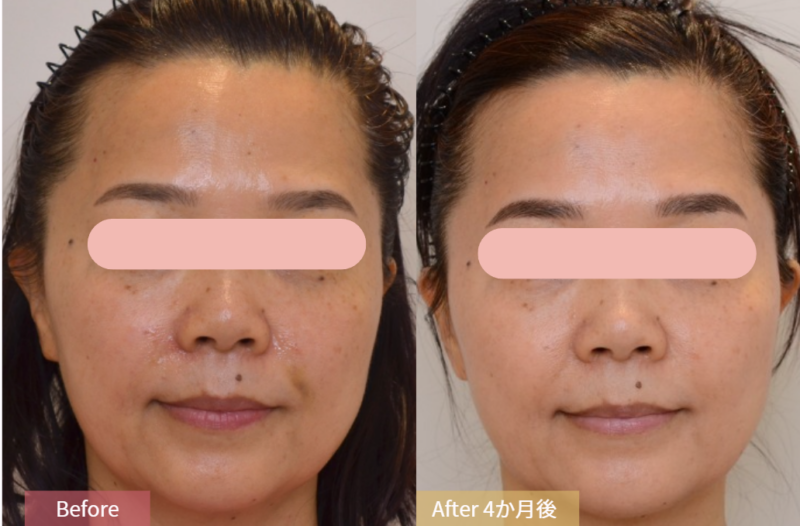コレジ（Corage 2.0）施術前後の肌状態を比較した院内症例写真