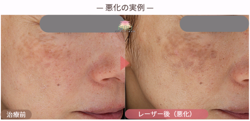 肝斑にレーザーを当てて悪化した症例のBefore After画像