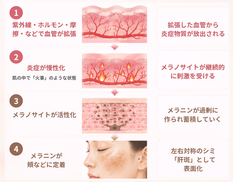 肝斑ができる仕組みを示した4段階の図解イラスト