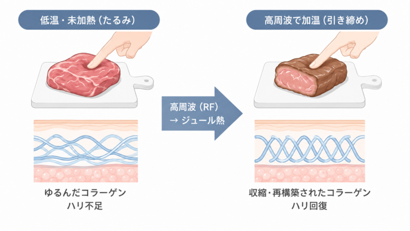 alt:高周波RFによるコラーゲン収縮のしくみを示した図解(未加熱でたるんだ状態と加温後に引き締まった状態の比較)